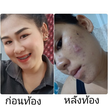 แม่ๆบ้านไหนสิวขึ้นเยอะแบบนี้ไหมค่ะ