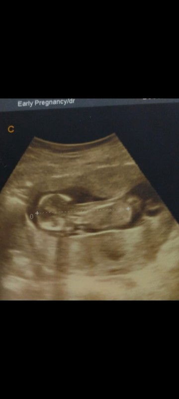 mohon doanya bun biar janinku tetap sehat dan kuat.?