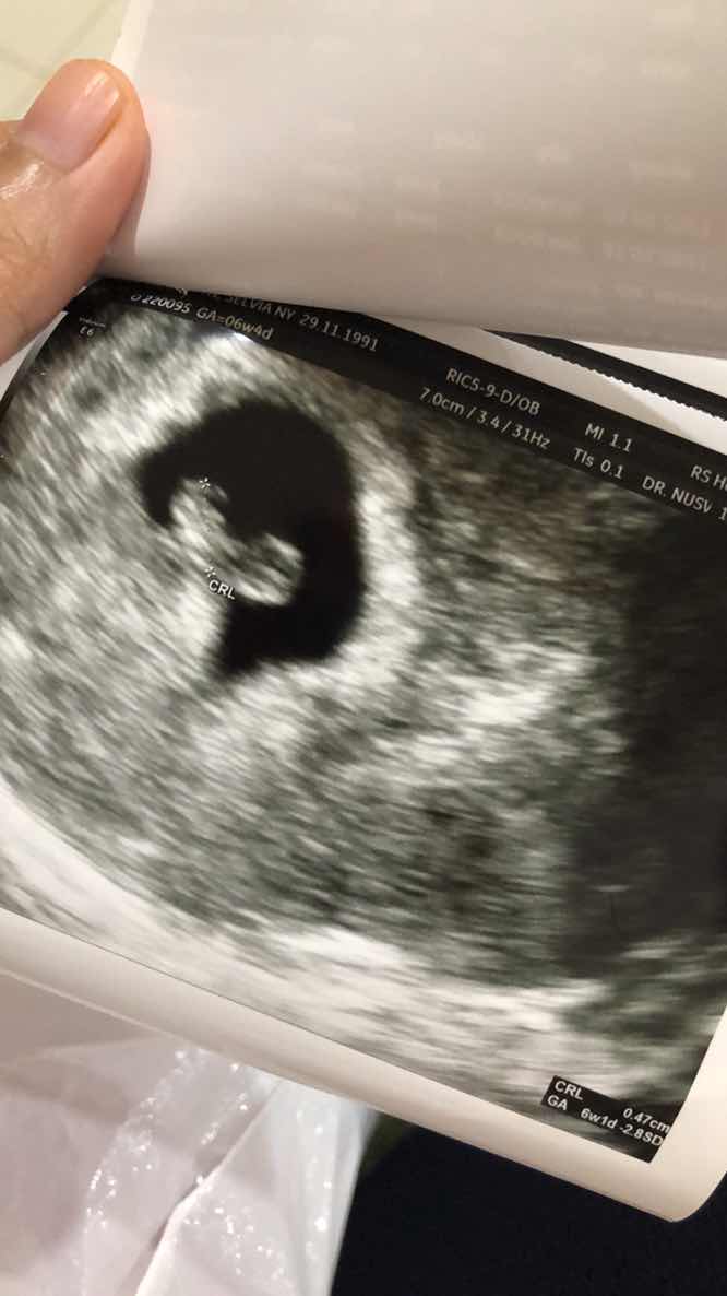 Alhmdulillah saya sudab hamil 6 minggu 4 hari dan sudah USG detak jantung janin sudah terdengar dan alhamdulillah sehat, tapi kendala yang saya alami..