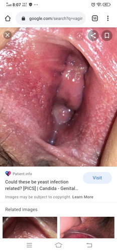 yeast infection