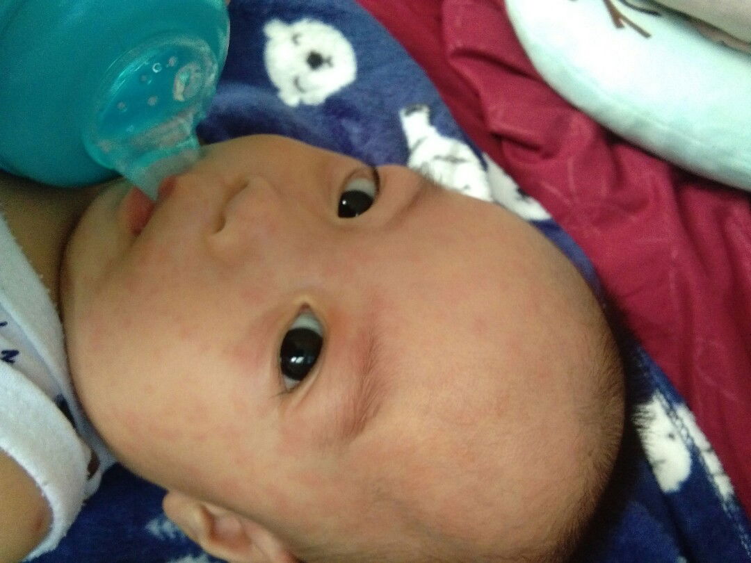 เด็ก6เดือนไข้2วัน วันที่3ไข้ลดมีผื่นออก หมอบอกส่าไข้