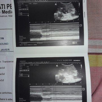 My Pelvic Ultrasound when i was 3months preggy