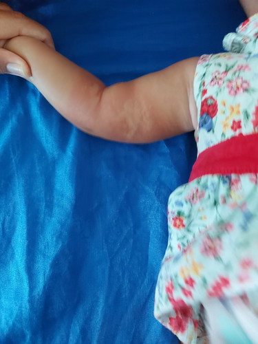 สาเหตุจากลมพิษหรือเกิดจากการแพ้อย่างอื่น