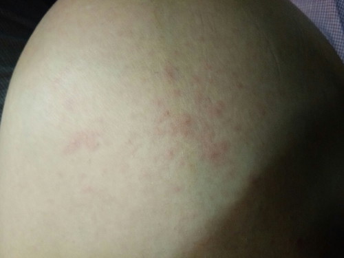 ผื่นคัน