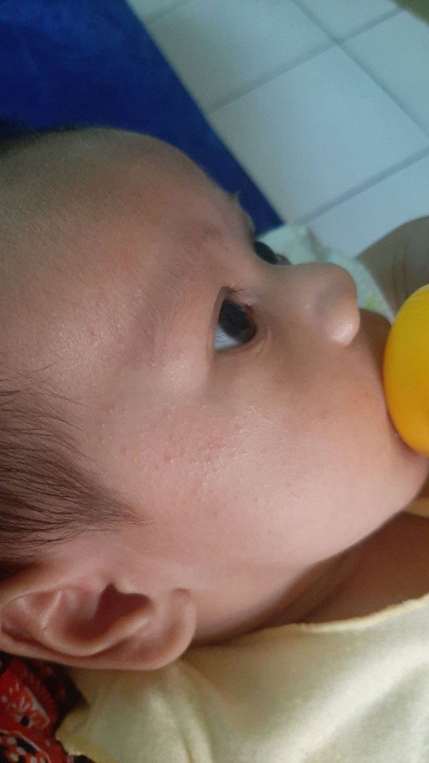 Muka bayi beruntusan
