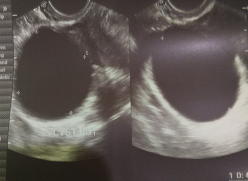 ovarian cyst