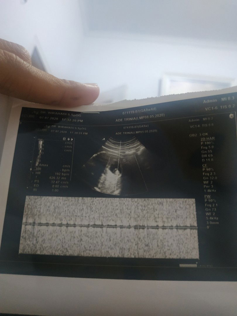 dekat jantung janin cepat