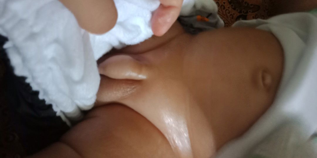 benjolan disekitar alat kelamin bayi