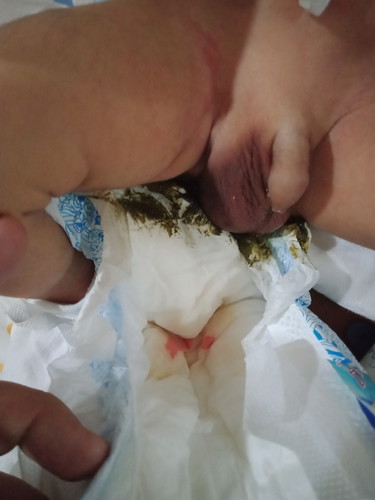 Dugo sa ihi ni lo