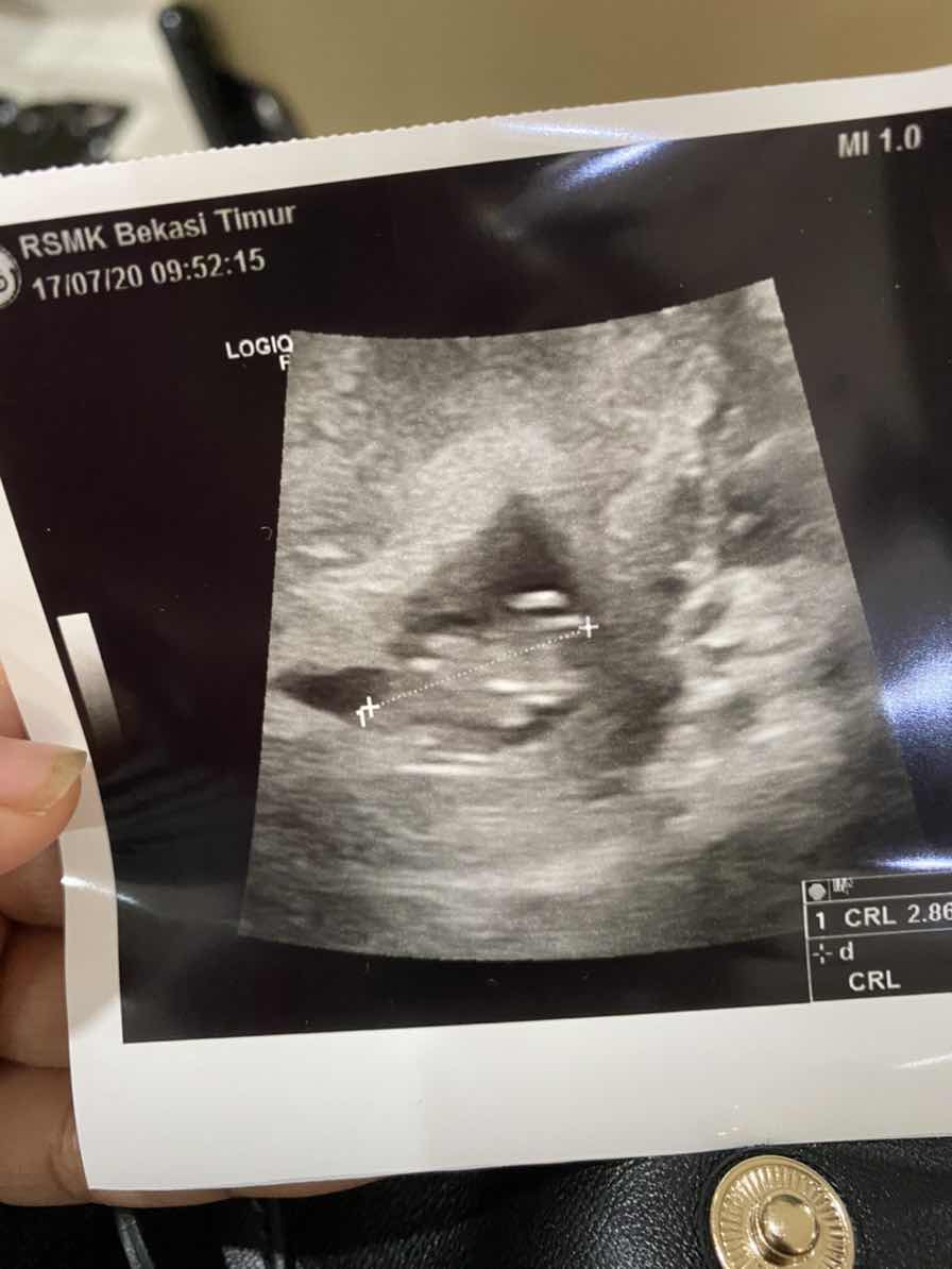 Usia kandungan berbeda saat diusg