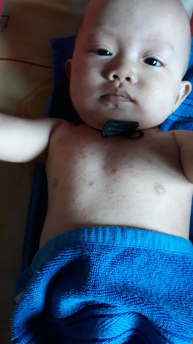 ni bun anak saya di bagian dada nya keluar bintik2 ginini alergi or biang keringet ya