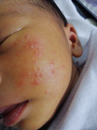 Heat Rash?