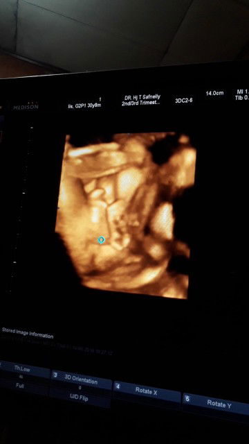 punya USG 4D jenis kelamin yang menunjukan perempuan ga