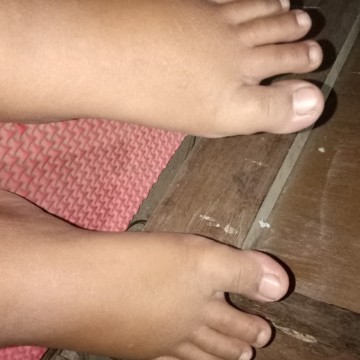 kaki bengkak