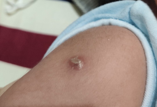 INJECTION SITE