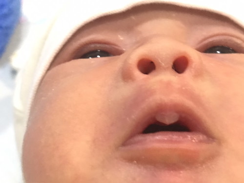 ลูกชายอายุ 13วัน ปากบนตรงกลางมีเม็ดใสๆ ลูกเป็นอะไรคะ ต้องไปหาหมอไหมคะ