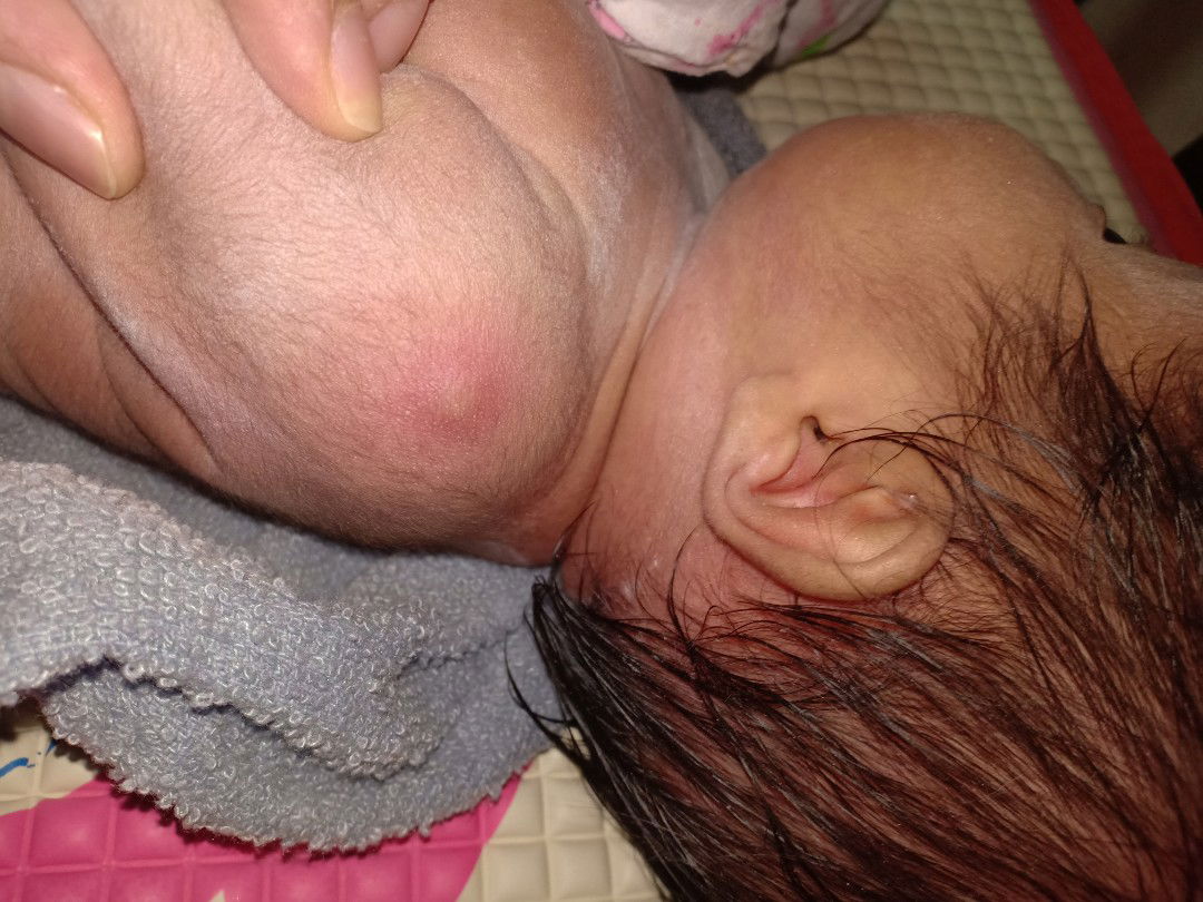 ลูกสาวเป็นตุ่มเหมือนหนอง ลูกคุณแม่ท่านไหนเคยเป็นบ้างคะ