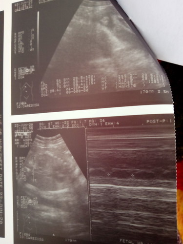 ultrasound