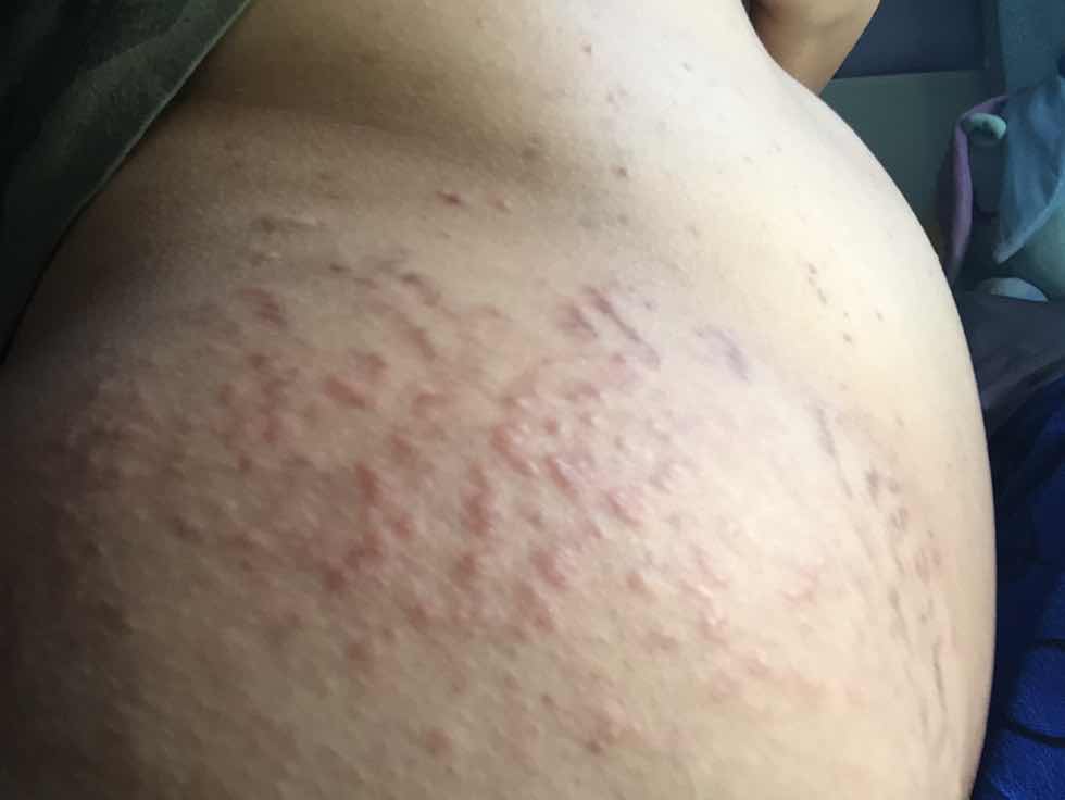 ผื่นที่ท้องรักษายังไง