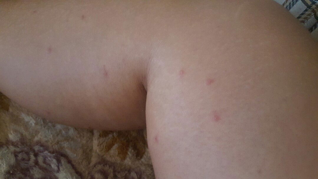 skin allergy/ itchy