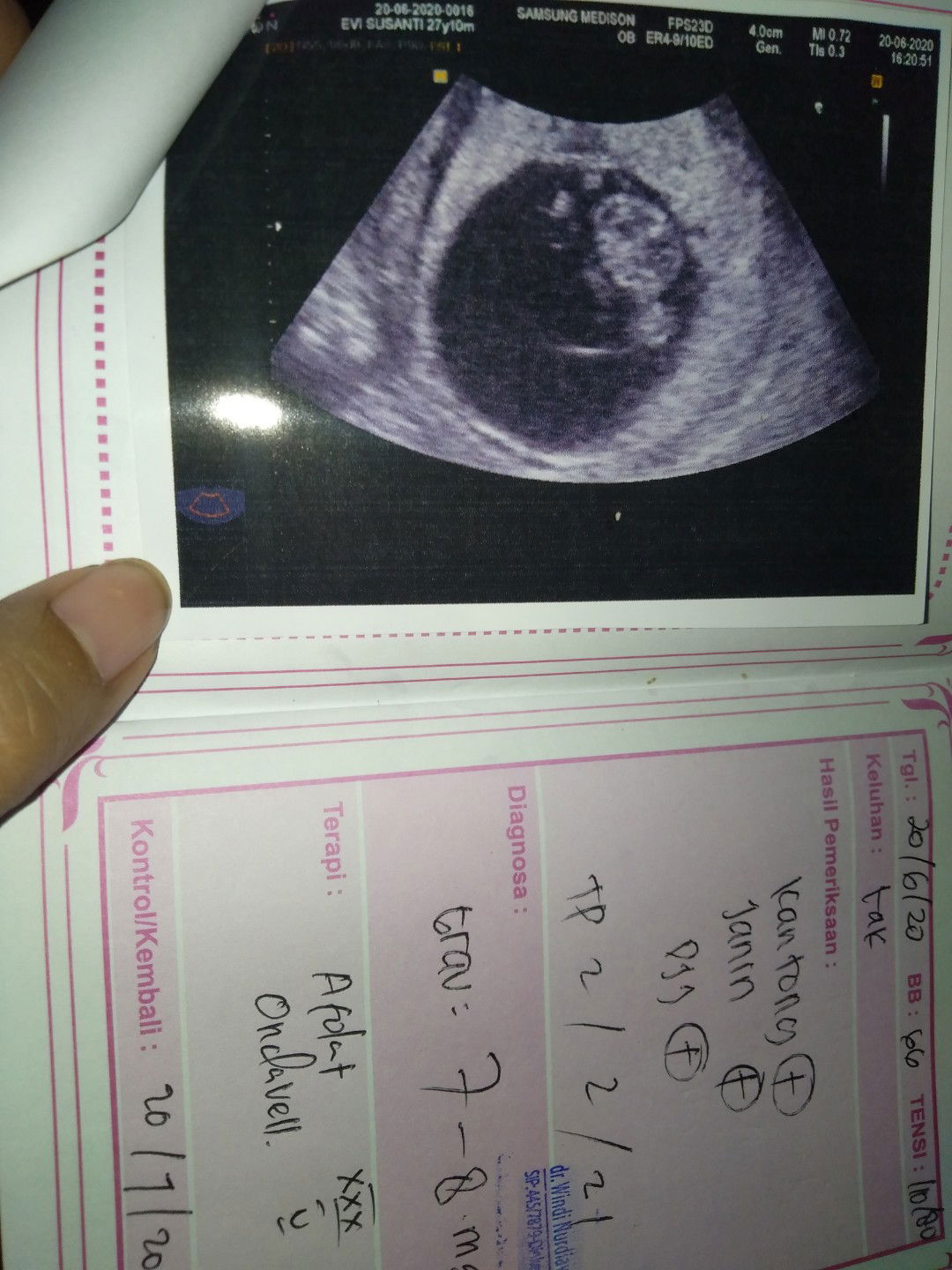 Alhamdulillah Hasil Usg Baik