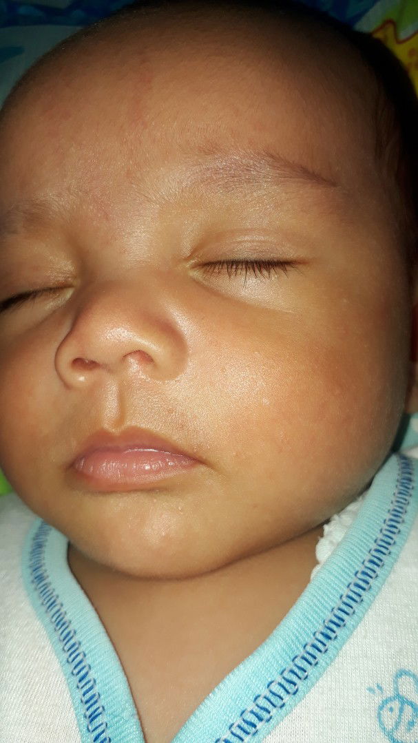 bruntusan pada wajah bayi