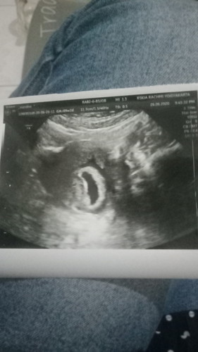 divonis BO usia 9minggu