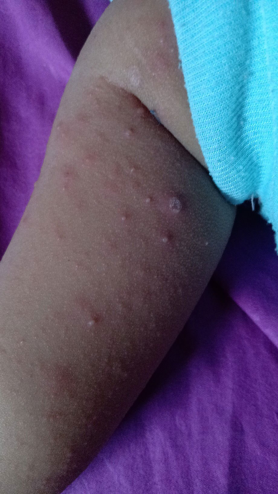 Bintik merah berisi cairan