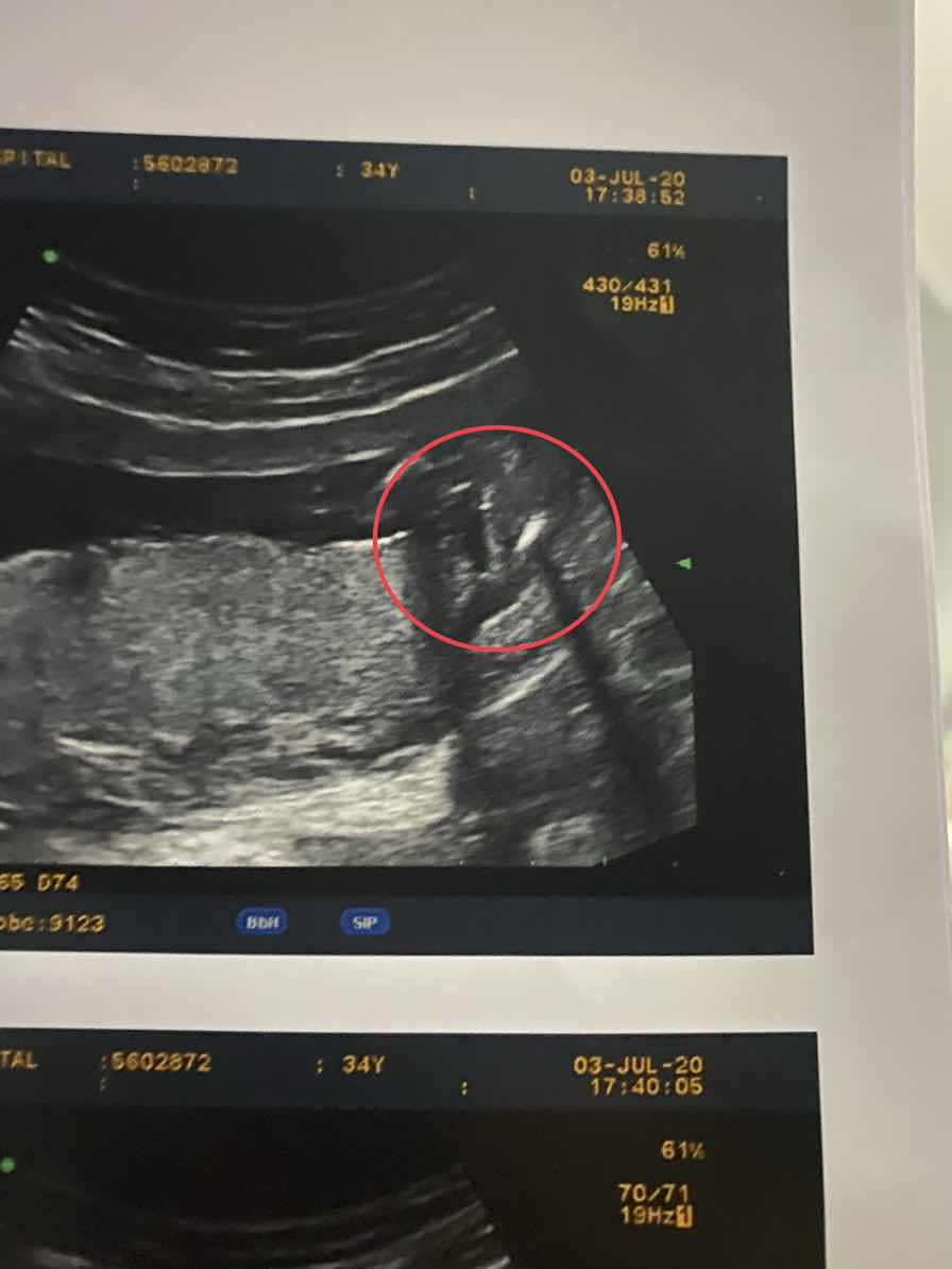 16weeks แต่ยังไม่เห็นเพศ