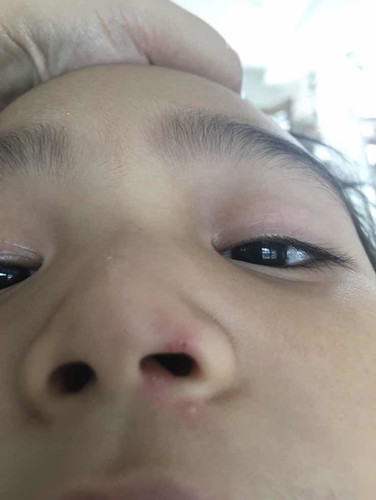 pimple like