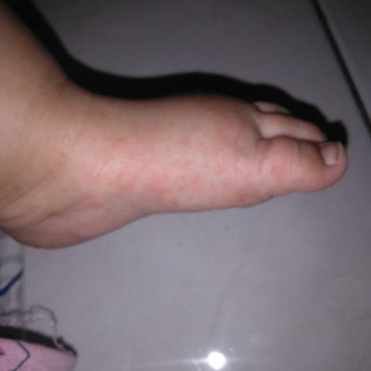 Bintik Bintik Dikaki