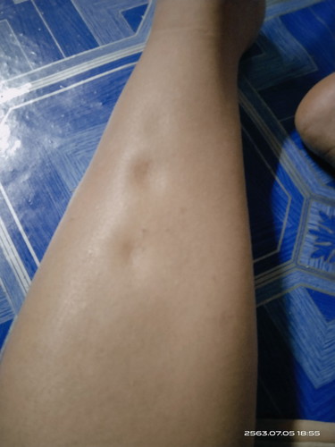 เท้าบวม