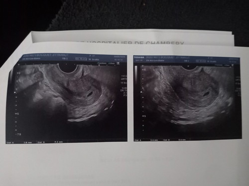 อัลตร้าซาวด์ไม่พบลูก (ท้องแรก)