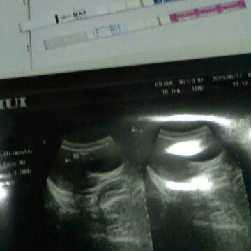 usg 5 minggu masih kantong