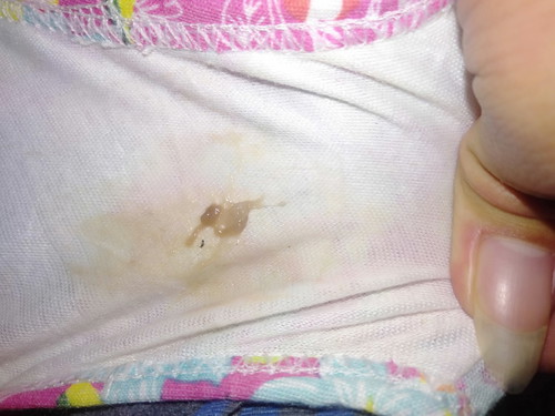 mucus plug
