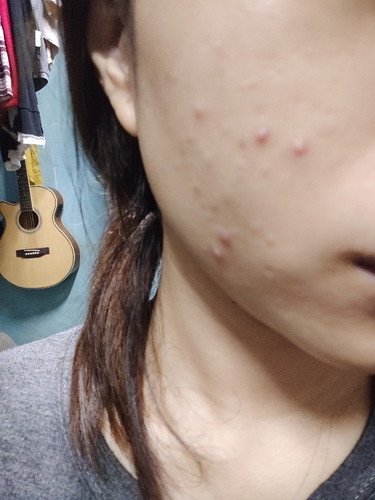 Pimples