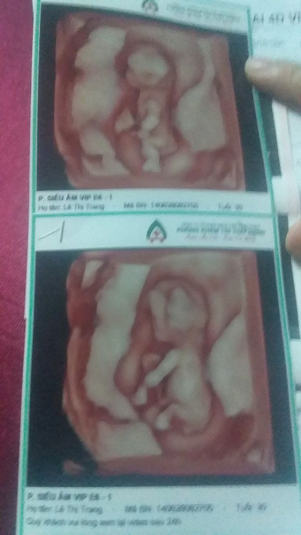 mốc  siêu  âm  12w ạ