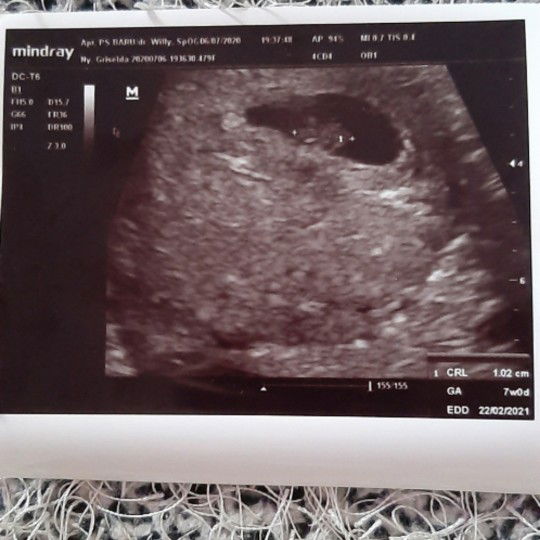 hasil usg 7 minggu