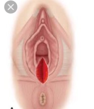 แผลฝีเย็บปริ เเต่เเผลเเห้งเเล้ว ควรทำไงดี