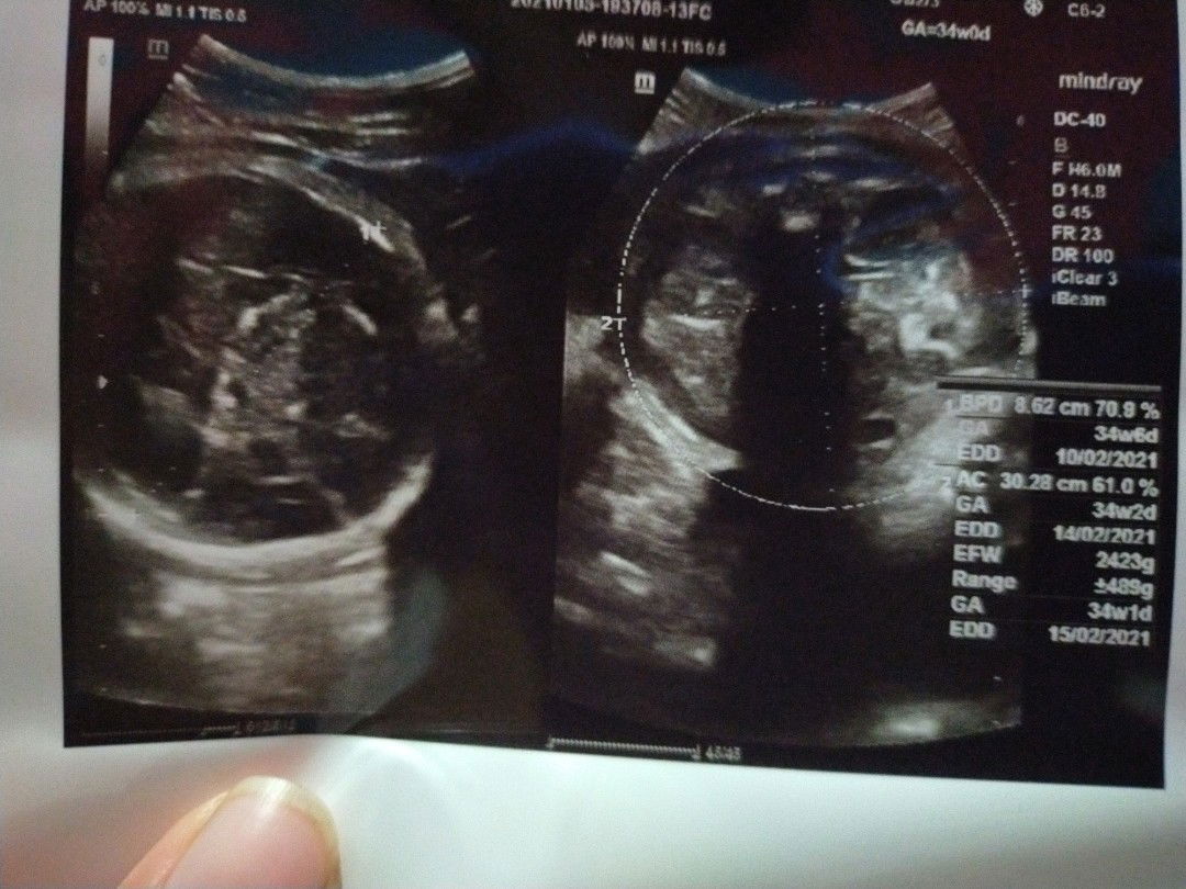 Bb janin kegedean gak