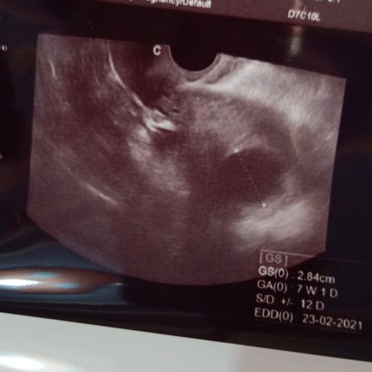 hamil 7minggu di USG .kaya gini...nggak tau.perasaan campur aduk bgt.