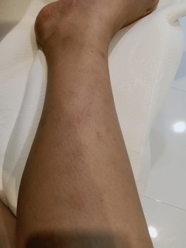 เป็นผื่นคันที่ขา