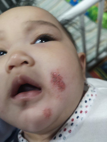 ผื่นในเด็ก