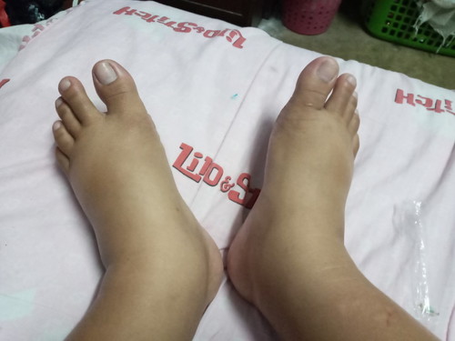 เท้าบวม