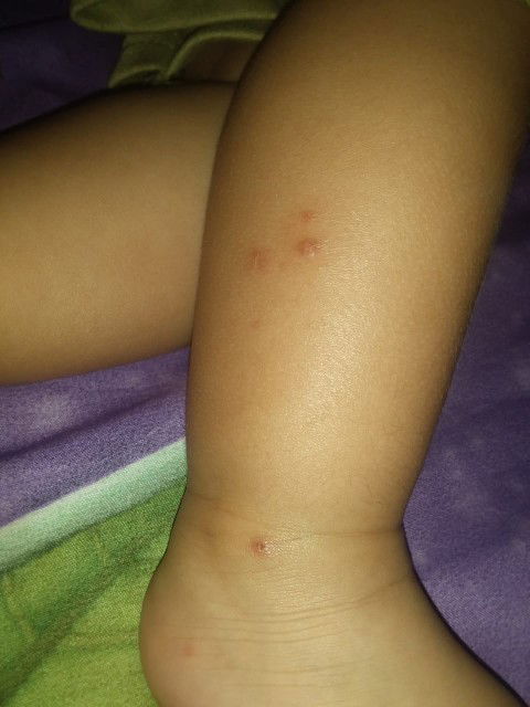 luka dikaki anak 8 bulan