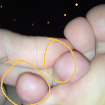 bund ada yg pernah kaya aku ga? di kaki aku kaya ada putih gt dalemnya. gatel banget