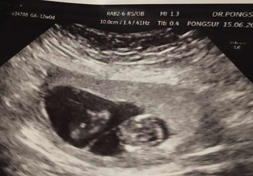 ท้องแฝดค่ะคนล่ะถุงคนน้องกับคนพี่ห่างกัน8วันคนพี่12วีค+1คนน้อง11วีค