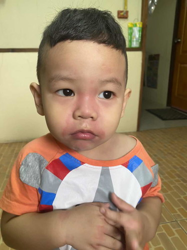 ลูกเป็นลมพิษ