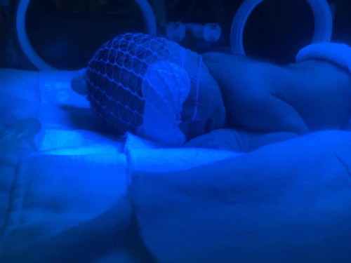 Newborn jaundice - how to improve it