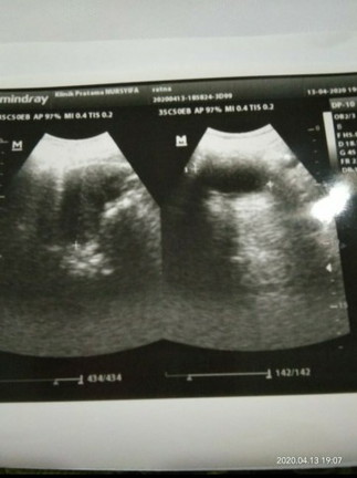 Ini usia kandungan 3 buln,, apakah aku benar" hamil.???